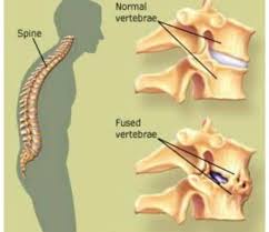 حقيقة  التهاب الفقار اللاصق